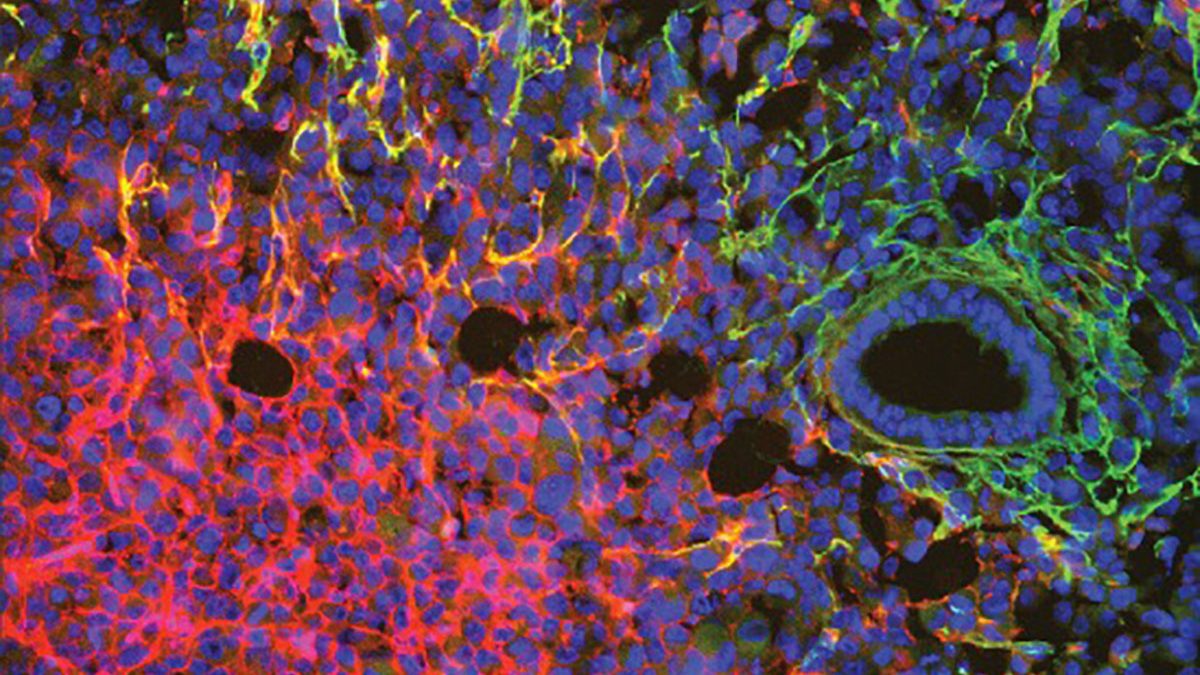 A triple negative breast cancer cell line stained for endothelial cells and blood vessel content. Using immunofluorescence, the researchers showed that blood vessels in the cell line are leaky.