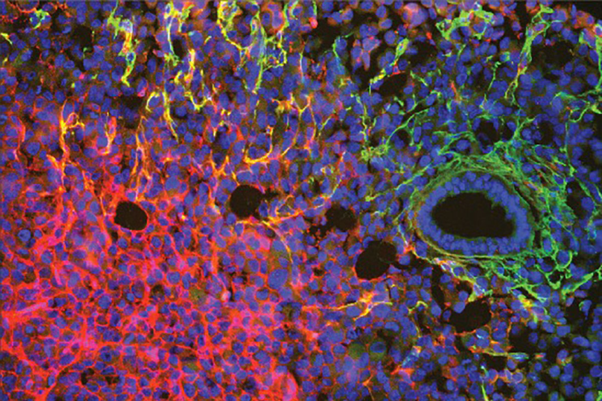 A triple negative breast cancer cell line stained for endothelial cells and blood vessel content. Using immunofluorescence, the researchers showed that blood vessels in the cell line are leaky.