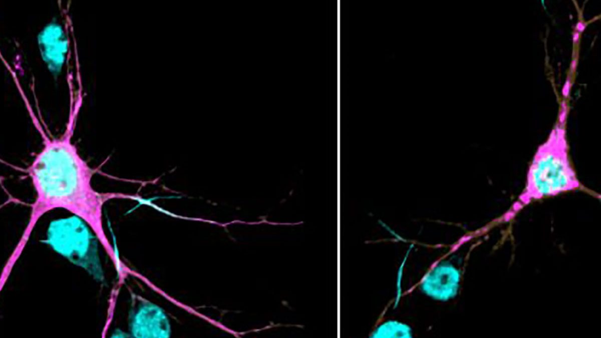 Right, βII-spectrin (magenta) forms aggregates throughout neurites of a mouse cortical neuron expressing one of the human SPTBN1 variants. (Lorenzo Lab)