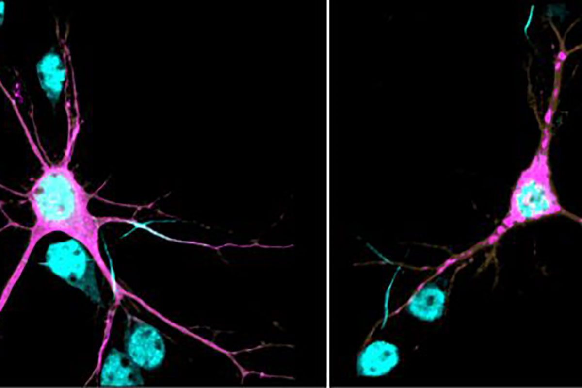 Right, βII-spectrin (magenta) forms aggregates throughout neurites of a mouse cortical neuron expressing one of the human SPTBN1 variants. (Lorenzo Lab)